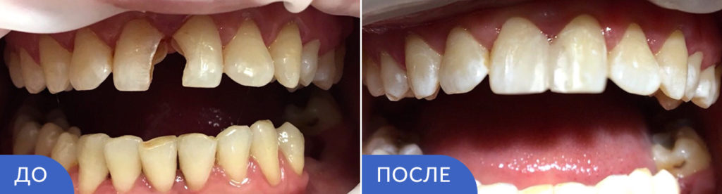 При реставрации зуба удаляют нерв